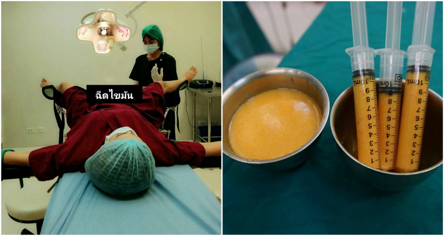 Women in Thailand Are Now Getting $1,500 Surgery for ‘3D Vaginas’