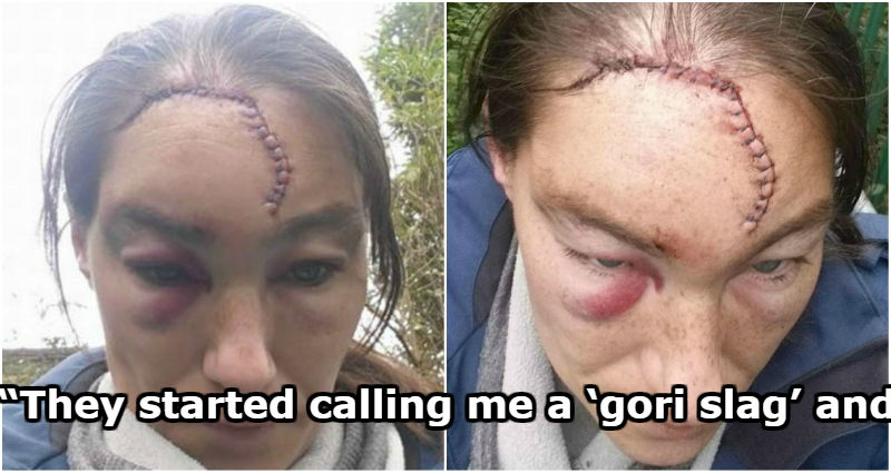 Sexist Men Target UK Woman in Brutal Attack That Exposed Her Skull