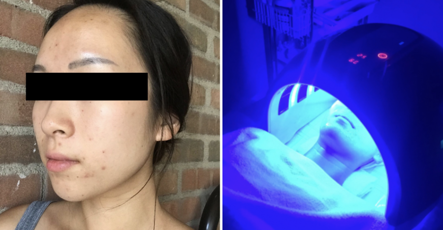 I Spent Over $500 at a Korean Skincare Clinic for Acne and Here Are the Results