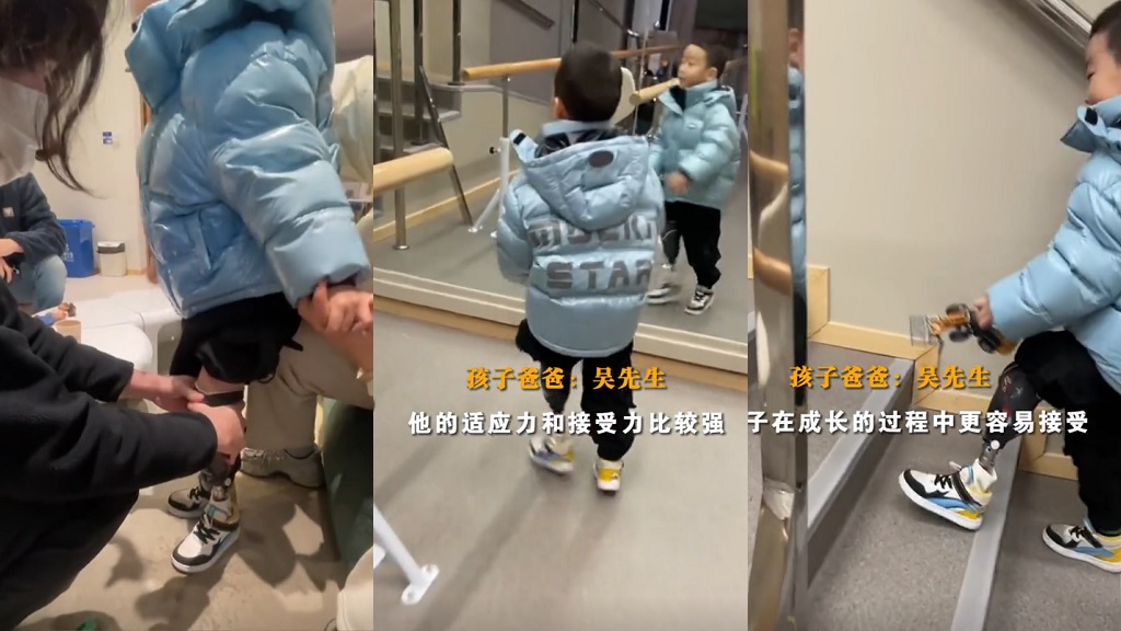 Chinese toddler prosthetic leg