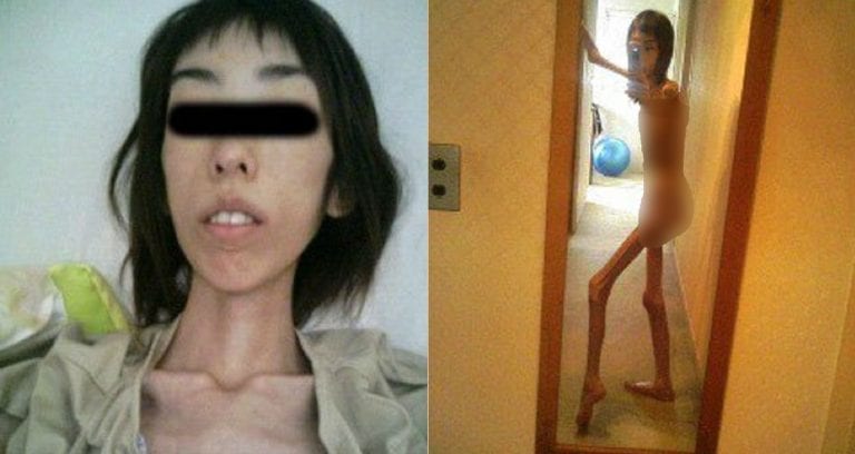 Japanese Abuse Survivor Shares Heartbreaking Photos of Life at 37 Pounds