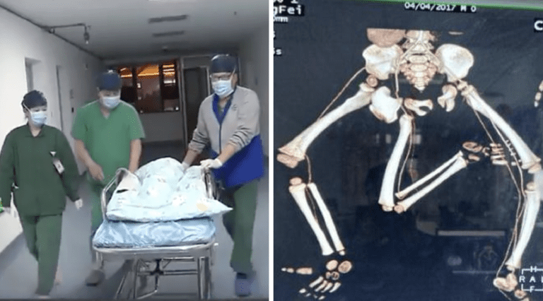 Baby Born With Three Legs Undergoes Complex 10-Hour Surgery in China