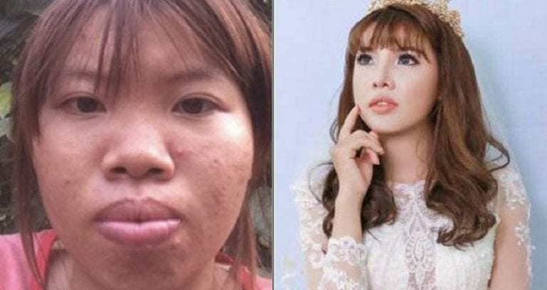 Bullied Vietnamese Girl Regains Self-Confidence With $14,000 of Plastic Surgery