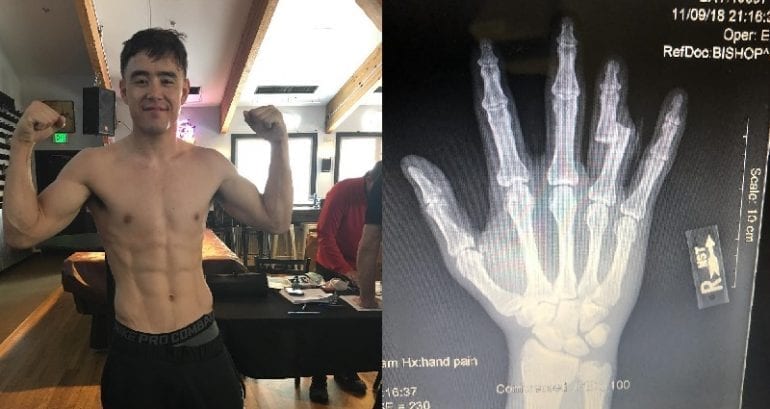 MMA Fighter Harvey Park Wins Fight With Bone Sticking Out of His Finger