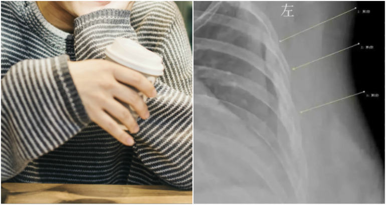 Chinese Woman Who Drank 10 CUPS of Coffee a Day for 7 Years Now Has the Bones of a Grandma