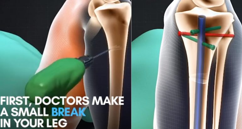 Some Asians Want This Painful Leg-Lengthening Surgery to Be Taller and It Shows