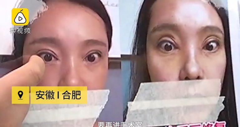 Woman Can’t Close Her Eyes After 2 Botched Double Eyelid Surgeries