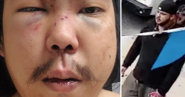 Asian Family Brutally Attacked in NYC Subway Needs Plates in Face, Other Surgeries