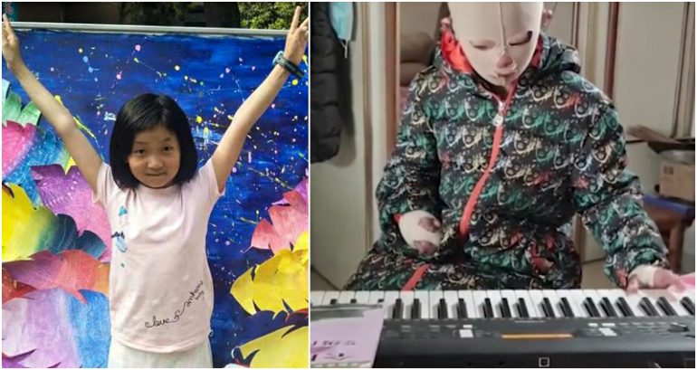 Chinese girl, 11, inspires millions by continuing to play the piano after a fire burned most of her body