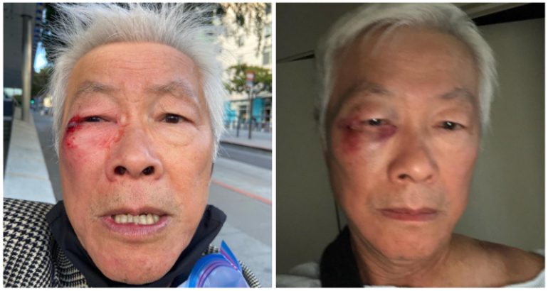 ‘I’m lucky to be alive’: SF commissioner-at-large punched in the face in unprovoked attack
