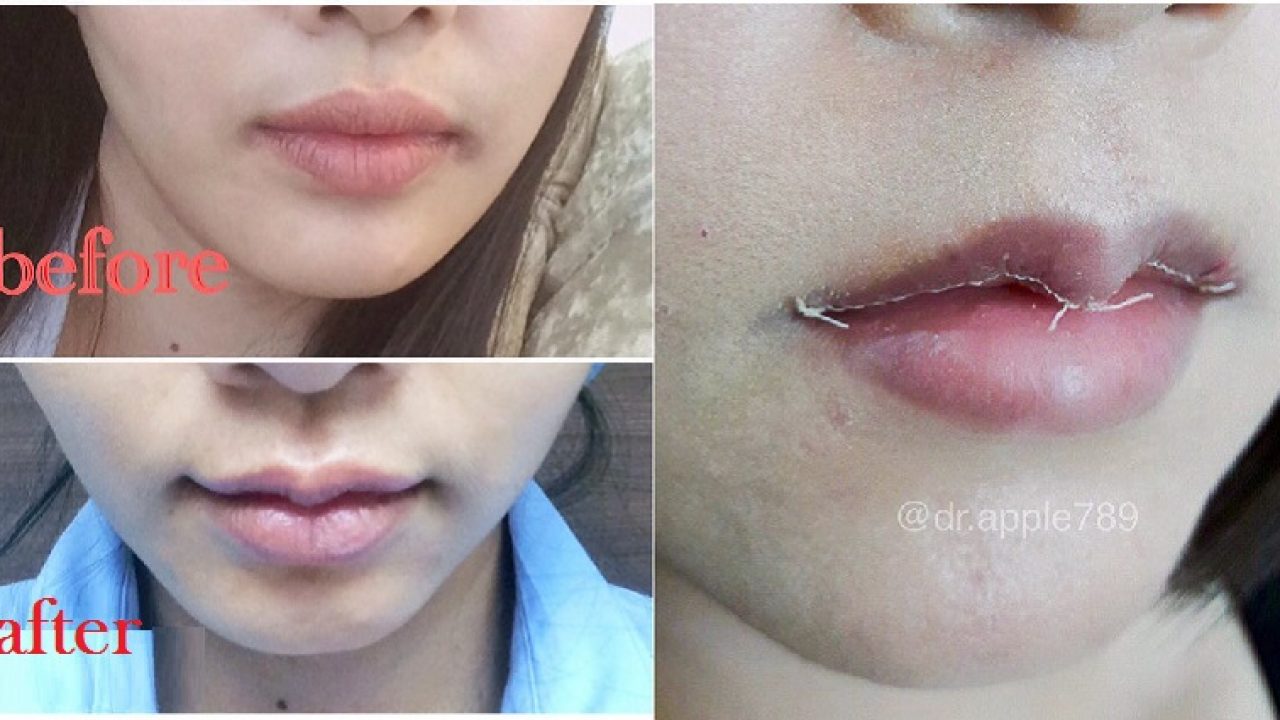 Surgery To Have Thinner Caucasian Lips Viruses, fungi and bacteria can easi...
